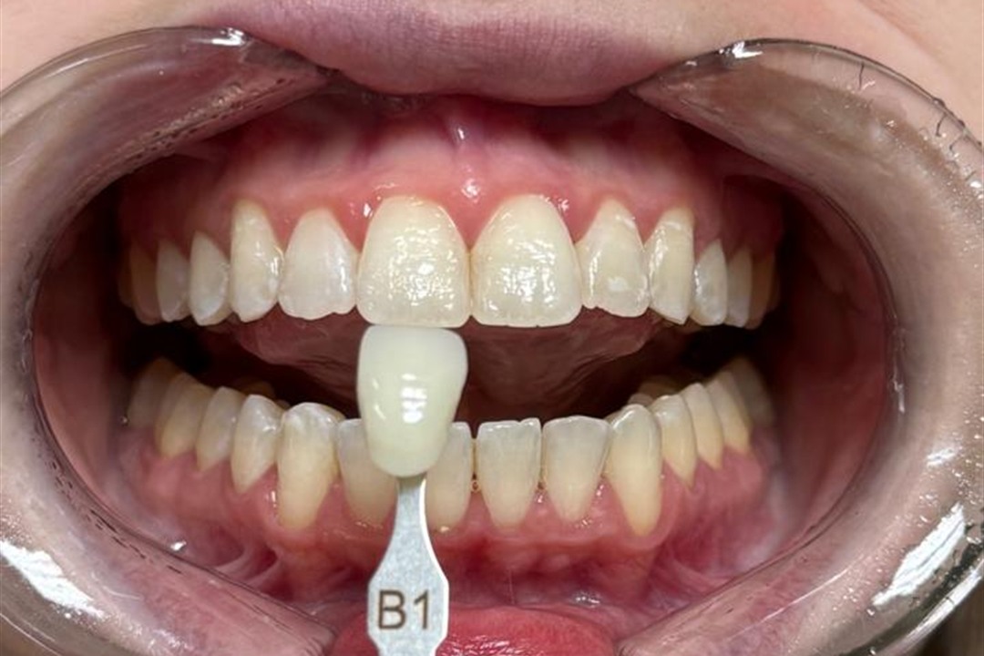 Sorriso depois do clareamento dental